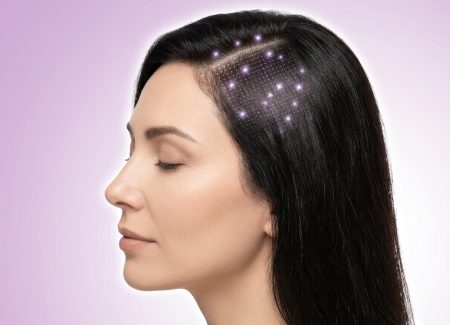 میکروتزریق مزوتراپی روی پوست سر یک بانو در مطب مرزداران تهران